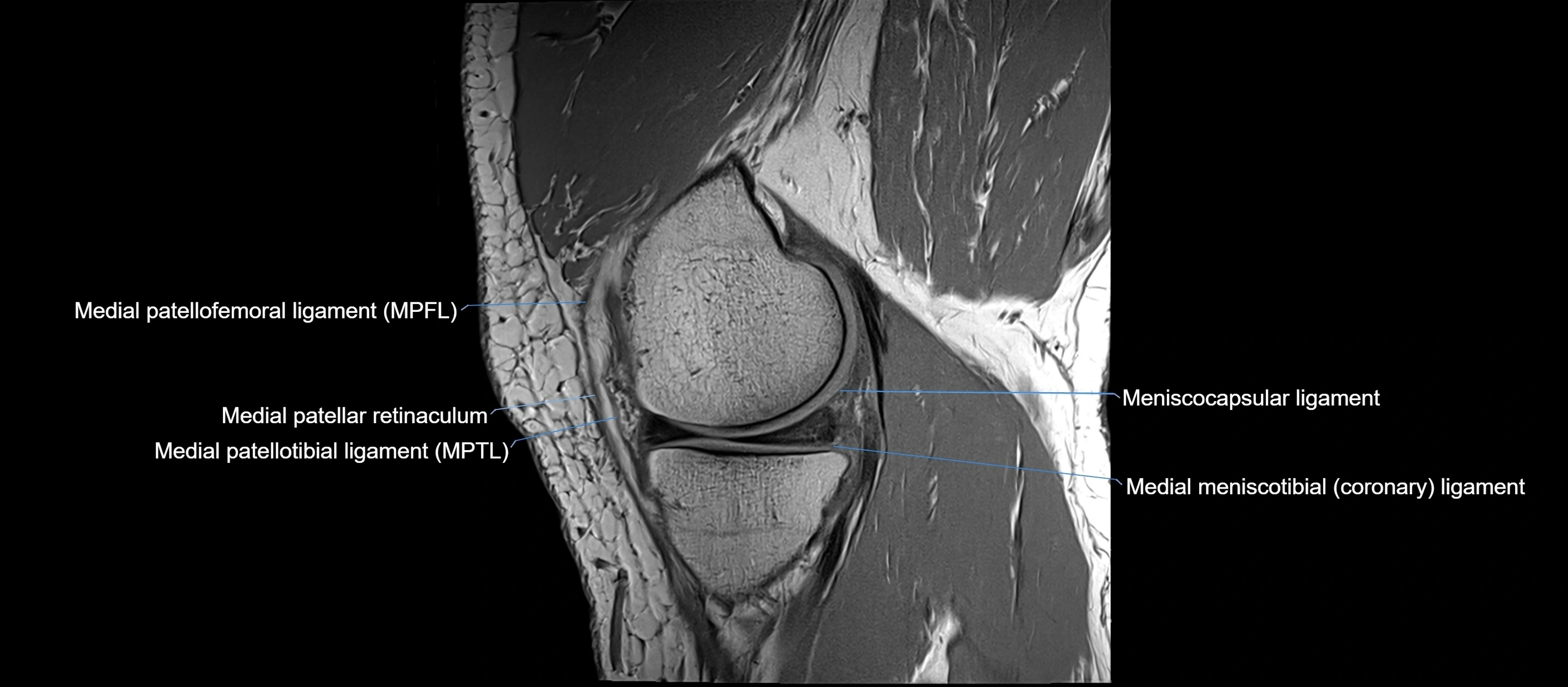 MRI sagittal  ligaments cross sectional anatomy 3T  radiology  image-img-00001-00014.webp